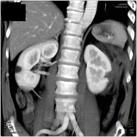 Renal Laceration with Hemoperitoneum - Kidney Case Studies - CTisus CT ...