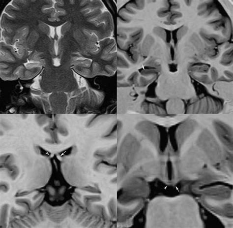 Right temporal lobe epilepsy. On the T2-weighted FSE image, there is an ...