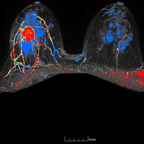 Radiology Fellowships Nyu Langone Health