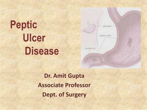 Peptic Ulcer Diseasepptx