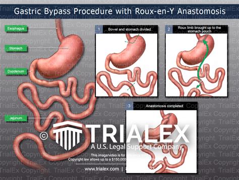 Gastric Bypass Procedure With Roux En Y Anastomosis Trialquest