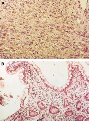 A Histology Of The Lesion From The Hard Palate Showing Features Of