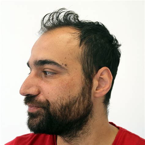 3810 Grafts Vorher Nachher Dr Resul Yaman Haar Klinik