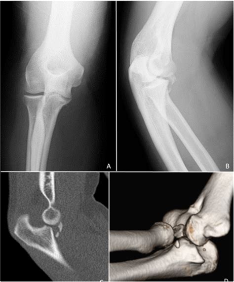 Anteroposterior A And Lateral B Plain Radiographs Of The Elbow