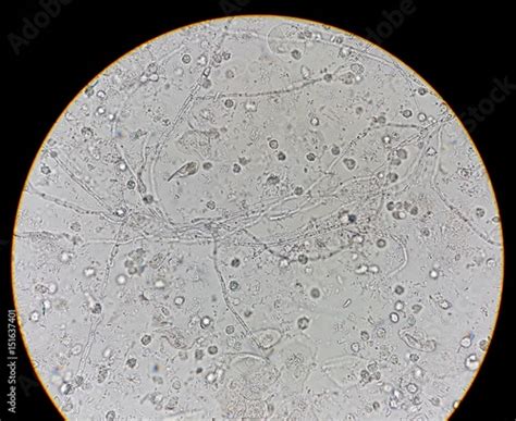 Abnormal Result Of Urinalysis Examination From Microscopic Method Under