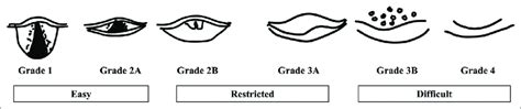 Modified Cormack Lehane Grading For Laryngeal View Grade 1 Most Of The