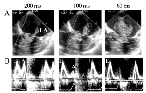 Echocardiographic Doppler Data For A Patient With Hypertrophic Obstruc