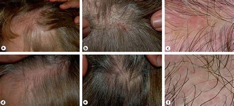 Figure 2 from Red Scalp Disease – A Rosacea-Like Dermatosis of the ...