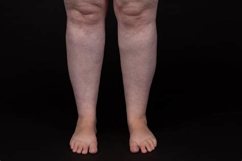 What Does Lipoedema Look Like? — Lipoedema Australia