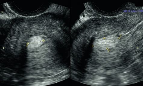 Uterine Polyps Ultrasound