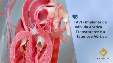 TAVI Implante de Válvula Aórtica Transcateter e a Estenose Aórtica