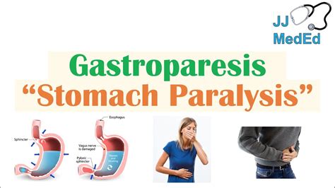 Understanding Stomach Paralysis Causes Symptoms And Treatments