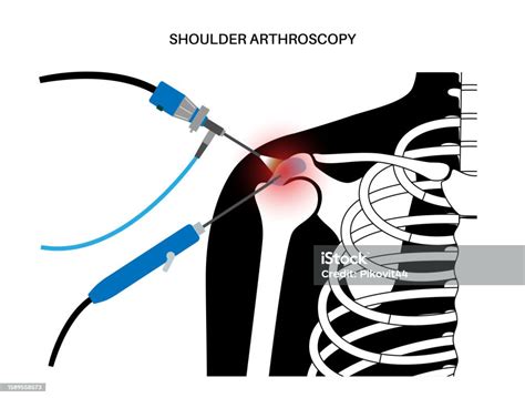 Shoulder Arthroscopy Poster Stock Illustration Download Image Now Anatomy Arthritis