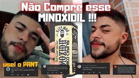 Minoxidil 10 Dom Pelo Respondendo INSCRITOS E Dando Dicas Ep 02