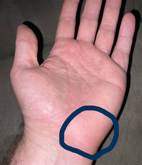 What Is The Medical Term For This Part Of The Palm Rorthopaedics