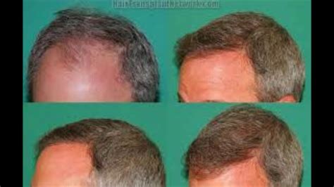 Hair Regain Solution How To Stop Hair Damaging For Men Youtube