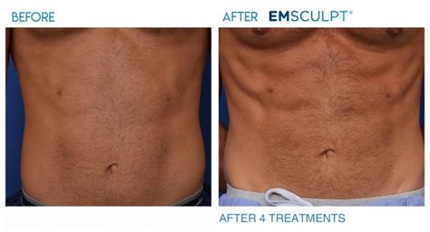 Renewal Skin Spa | Emsculpt-abs-before-and-after