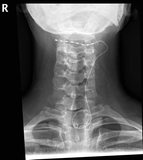 Implantable Technology For Pain Management Anaesthesia Intensive