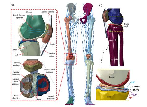 Importance Of Posterior Tibial Slope In Joint Kinematics With An