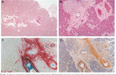 Figure 1 From Activation Of Pancreatic Stellate Cells In Human And