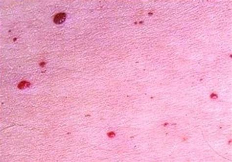 Cherry Angioma Pictures Removal Causes Home Treatment