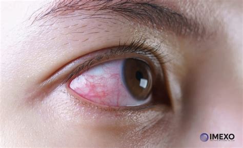 Ojos Rojos Causas Y Complicaciones Instituto Mexicano Ojo