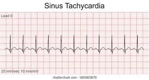 Cardiac Arrhythmia Flashcards Quizlet