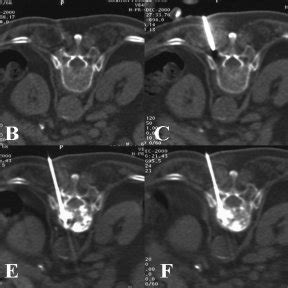 Sixty Eight Year Old Female Patient With Osteoporosis A Mri Shows