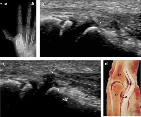 Metacarpophalangeal (MCP) joint dorsal dislocation and volar plate ...