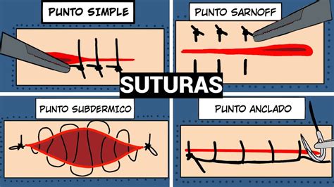 PUNTOS DE SUTURA QUIRURGICA SIMPLE SARNOFF SUBDERMICO Y ANCLADO