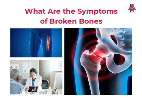 Broken Bones (Fractures): Types, Causes, Symptoms, and Treatment | ER ...