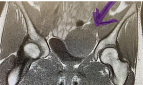 Hip clicking fixed with surgery? : r/HipImpingement