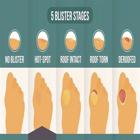 Blister Hot Spot | Hot Spot On Foot: A Pre-Blister State