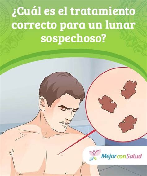 Cuál es el tratamiento correcto para un lunar sospechoso Un lunar