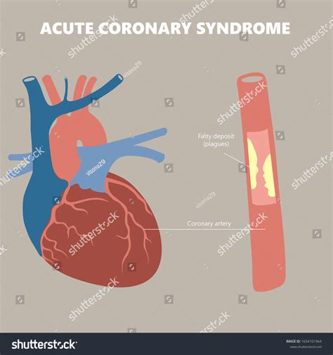 Medical Illustration Atherosclerotic Plaque Development Build Stock