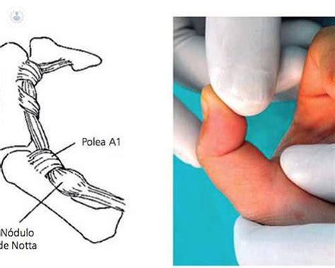 Pulgar En Resorte O Dedo En Gatillo Causas Diagn Stico Y Tratamiento