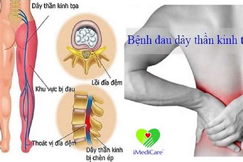 Dau Day Than Kinh Toa Imedicare Vn Hoi Chung Dau Than Kinh Flickr