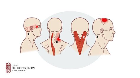 Pontos Gatilho Pontos de Tensão Muscular Clínica Dr Hong Jin Pai