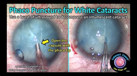 Cataractcoach Phaco Puncture For White Cataracts Youtube