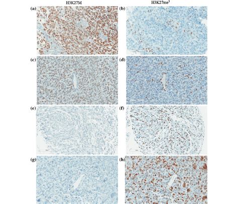 Immunohistochemical Ihc Staining Of Pediatric High Grade Astrocytomas