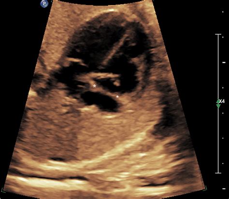 Figure From Prenatal Sonographic Findings Of Prominent Fetal