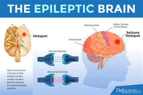 Epilepsy Risk Factors And Natural Support Strategies Drjockers