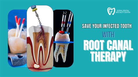 Root Canal Doral Fl