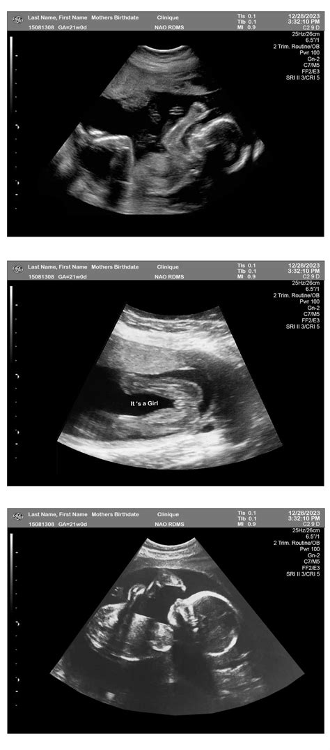 Fetuses Weeks Ultrasound Girl Ultrasounds