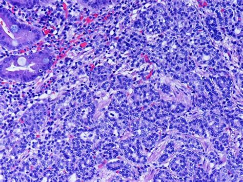 Composite Signet Ring Cell Neuroendocrine Carcinoma Of The Stomach With