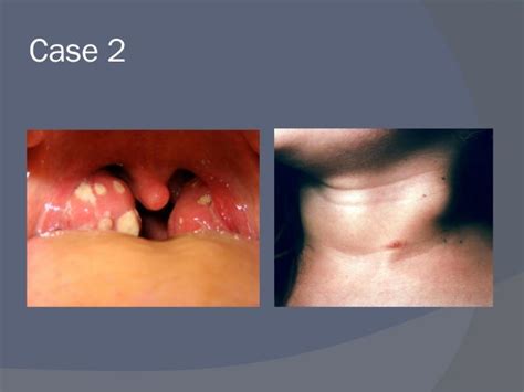 Acute Pharyngitis