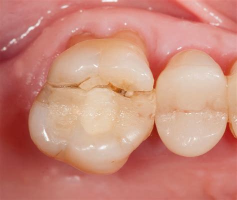 Fractured Cusp Molar