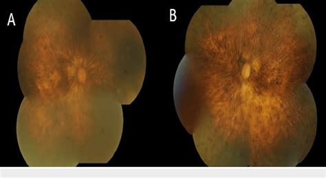 Figure From Bilateral Sequential Spontaneous Anterior Dislocated