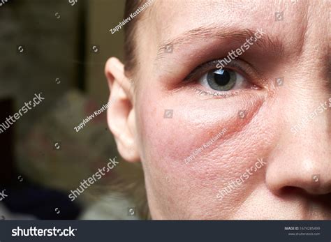 Eye Swelling Under The Eye