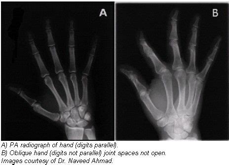 Radiographic Positioning Of The Hand Radiographic Examination Of The